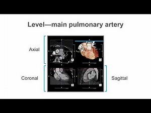 Identify normal heart structures on a cardiac CT scan | Medmastery