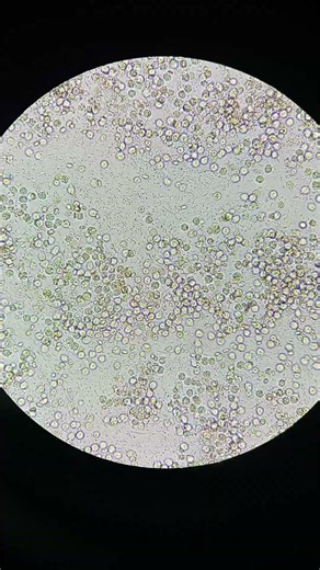 pus cell numerous bacteria ++++ nitrate positive urine R E ‪@mltwithmasood9010‬