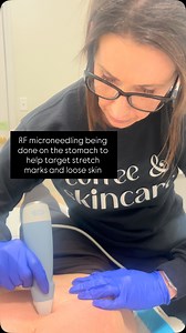 ✨ BTL Microneedling – More Than Just a Face Treatment! ✨ Did you know BTL microneedling isn’t just for your face? This advanced treatment can be done on multiple areas of the body to help you achieve smoother, firmer, more youthful skin—head to toe! 💉 Benefits Include: ✔️ Stimulates collagen elastin production ✔️ Reduces fine lines wrinkles ✔️ Improves skin tone texture ✔️ Targets stretch marks acne scars ✔️ Tightens loose or crepey skin 🧴 Treatable Areas: ✔️ Face & Neck ✔️ Stomach (stretch ma