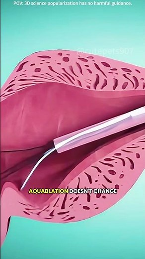 Aquablation therapy for enalrged prostate treatment!(3D animation) #drone #theflash #space