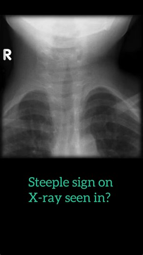 Xray- steeple sign; Diagnosis- croup in child #baby #medical #mbbs #xray #college #medico