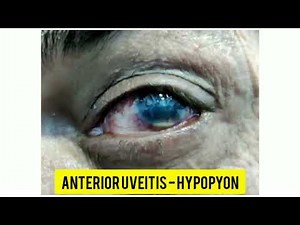 ANTERIOR UVEITIS WITH HYPOPYON
