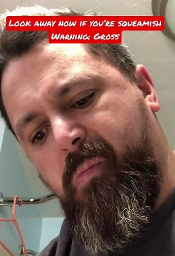 Draining preauricular cyst / pit