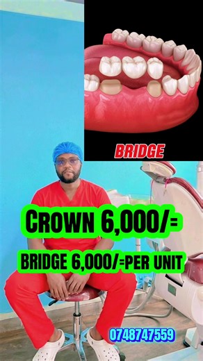 Understanding Crowns and Bridges for Dental Restoration