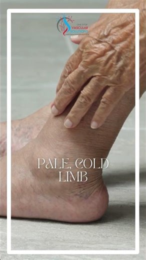 #Leg #pain Warning Signs You Should Never Ignore #vascularhealth