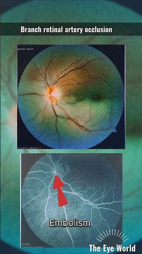The Eye World™:Branch retinal artery occlusion BRAO #ophthalmology #eyes #retina #youtubeshorts