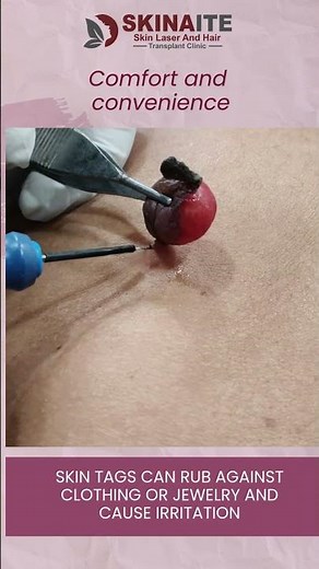 How Skin Tags Are Removed? | Painless & Safe Skin Tag Removal Procedure | Skinaite Clinic