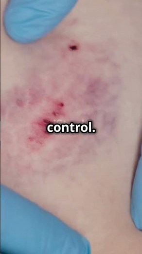 The Hidden Truth About Proteus Syndrome EXPOSED