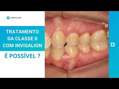 TRATAMENTO DA CLASSE II COM INVISALIGN: Aprenda a planejar com attachments e elásticos de Classe II
