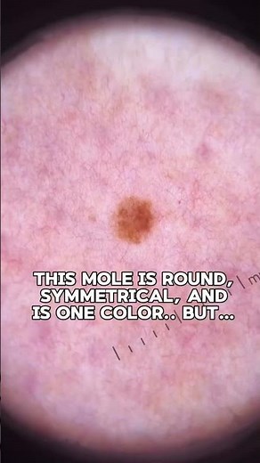 Normal appearing mole, or is it actually normal? This is not normal