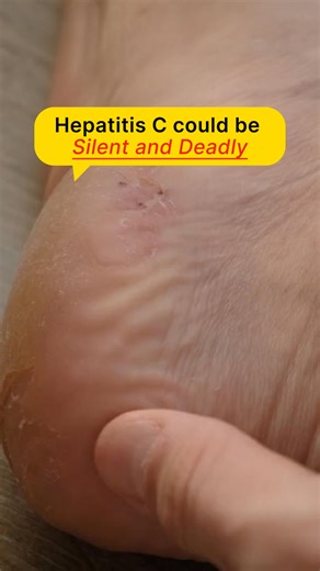 Find out why hepatitis C is silent but deadly — know its symptoms! | Health and Hygiene | Facebook