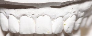 Prognathe : definition, causes et solutions - Dentaly