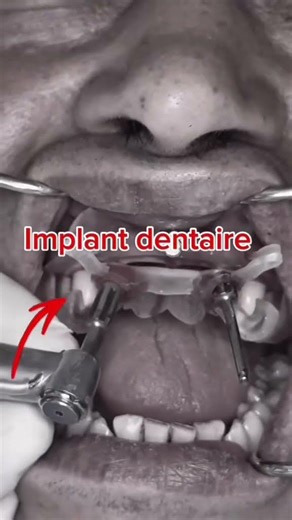 Chirurgie Guidée 3D (Guide à Étages) : Vos Dents Prêtes AVANT l'Implant ! 🦷🔬