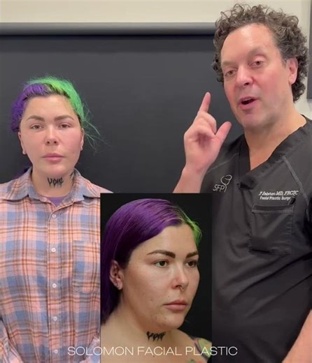 MINI DEEP PLANE FACELIFT BEFORE AND AFTER PHILIP SOLOMON