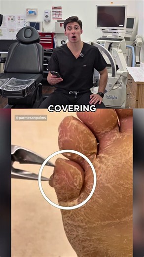 Callus Removal Gone Extreme