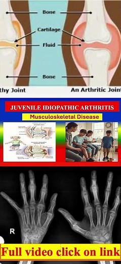 Juvenile Idiopathic Arthritis (JIA) Signs and Symptoms #medicalknowledgeonline #diagnosis #anatomy