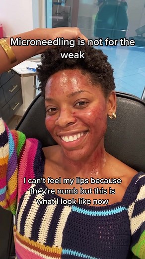 Smooth Skin Goals: Microneedling for Dark Skin & Hairline