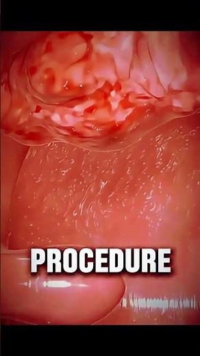 How Tonsil Removal Surgery Actually Works — A Clear & Simple Medical Breakdown | Tonsillectomy |