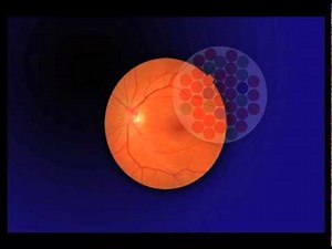 Color Vision Loss. - The 15 Visual Problems of Macular Degeneration