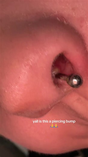 Understanding Piercing Bumps: What to Do Next