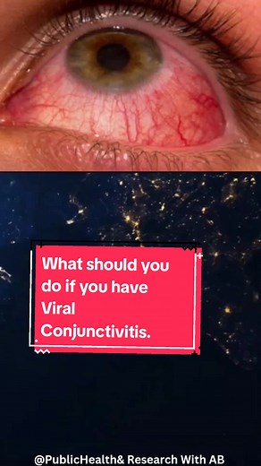 How to Treat Viral Conjunctivitis: Remedies and Prevention Tips