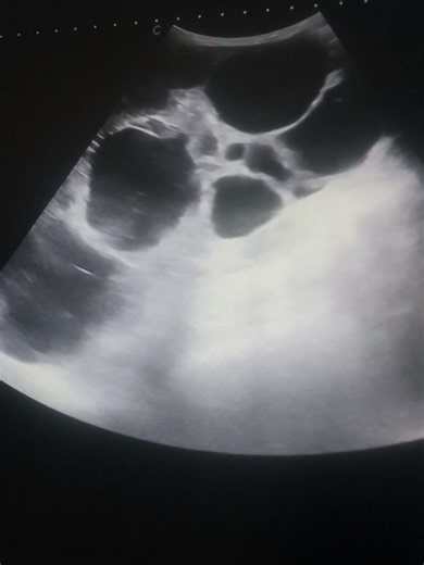 ADPKD Diagnosis in 40-Year-Old Mother