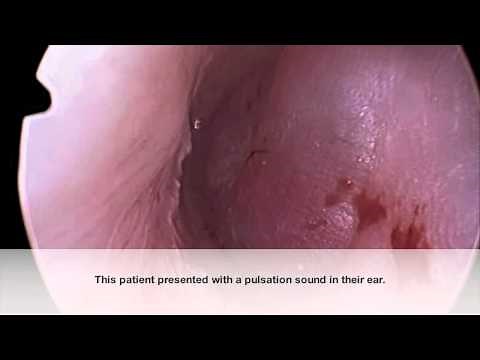Middle Ear Paraganglioma (Glomus Tumor) Endoscopy _ Dr Nirmal Patel