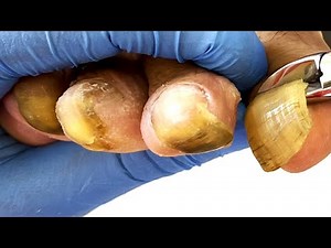 Long Toenails, Smooth Trimming And Care【Pedicure King】