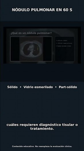 ¿Qué es un nódulo pulmonar? Sólido vs subsólido en 60 segundos #Shorts