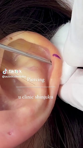 ヘリックスのピアッシング👨🏻‍⚕️🤍ྀིピアッサーまたはニードルでの施術が可能です👌🏻 #ユークリニック新宿 #軟骨ピアス #ヘリックス #トラガス #ラブレット #ニードル #ロブ