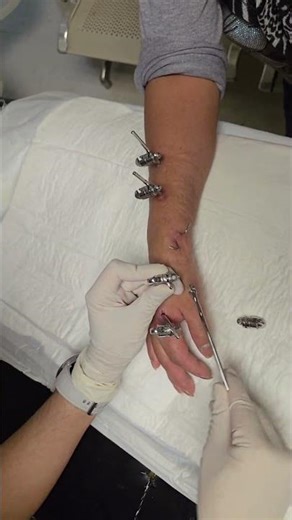 Extraccion de clavos y fijadores externos de fractura de muñeca consolidada