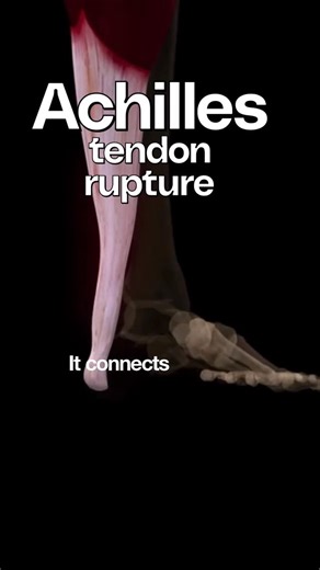 Bradley Blair Osteopath on Instagram: "Patients with an Achilles tendon rupture frequently present with complaints of a sudden snap in the lower calf associated with acute, severe pain. The patient reports feeling like he or she has been shot, kicked, or cut in the back of the leg, which may result in an inability to ambulate further. Most Achilles tendon tears occur in the left leg in the substance of the tendo-Achilles, approximately 2-6 cm above the calcaneal insertion of the tendon. That the
