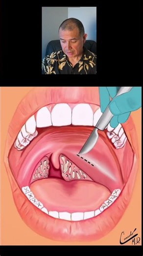 Peritonsillar Abscess Surgery #shorts