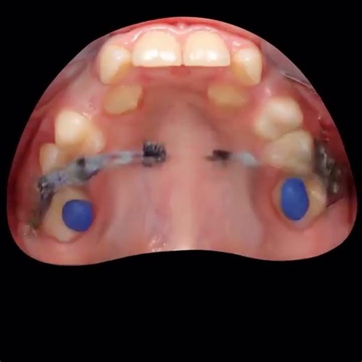 multiple canines disimpaction