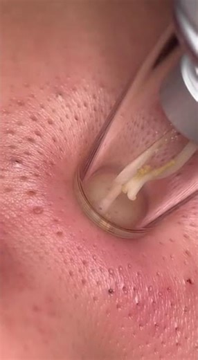 Blackhead Removal Tool Demonstration: Deep Pore Cleansing for Clear Skin