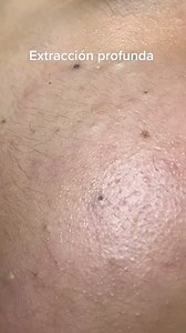 41 reactions | remove blackheads behind the ears..#blackhead #acne #comfortable #pimple #spueeze #tiktokHumildadConEstilo #humildad #Bendiciones #Viral #parati #foryou #fyp #mentemilionaria | BEL_SPA | Facebook