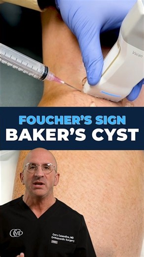 Lump Behind the Knee? What a Baker's Cyst Is Actually Telling You