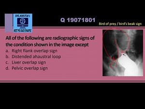 Sigmoid volvulus - Radiology signs