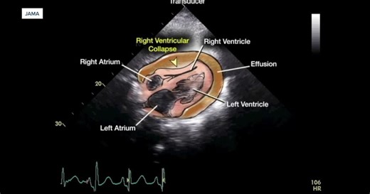 What is cardiac tamponade? Experts explain the rare condition after Nampa Mayor Rick Hogaboam's death