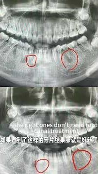 How to read dental X-rays for periapical periodontitis
