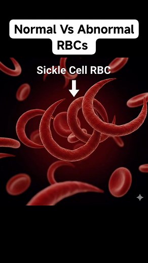 Morphologie des globules rouges que tout technicien de laboratoire devrait connaître | Biologies médicales