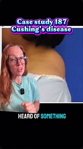 Case Study 187: Cushing’s Disease Cushing’s disease is a specific form of Cushing’s syndrome caused by a pituitary adenoma that secretes excess adrenocorticotropic hormone (ACTH) — driving the adrenal glands to produce excess cortisol. 📊 Facts & Figures: • Cushing’s disease accounts for 60–70% of endogenous Cushing’s syndrome cases. • It is 3–5 times more common in women, especially between the ages of 20–40. • Average tumor size is 5 mm, often invisible on MRI — making diagnosis challenging. •