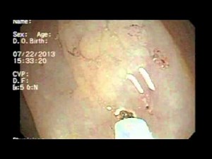 Polypectomy