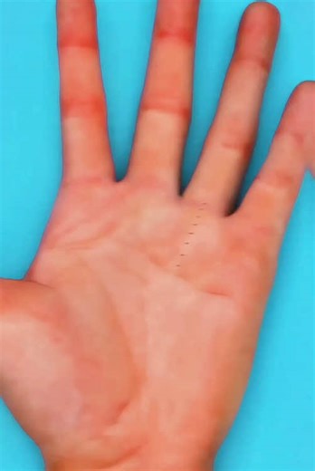 Understanding Trigger Finger Release Surgery Through 3D Animation