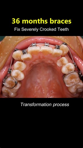 This is how braces fix CRAZY TEETH #braces #orthodontist #dentist #teeth