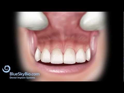 Patient Treatment Videos: Frenectomy
