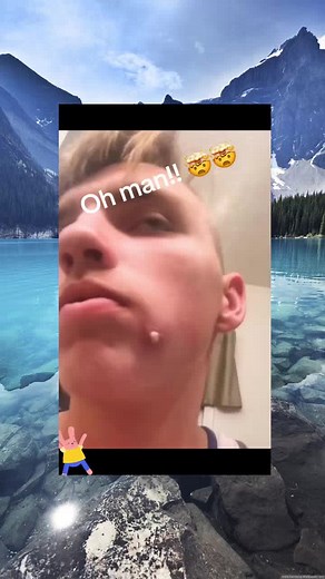 pimple acne cyst popping squeezeyuk explore satisfying video (386)