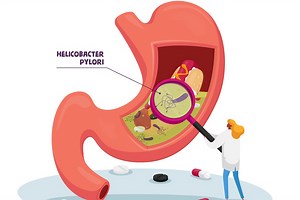 Nutri revela 7 alimentos que quem tem H. pylori deve ficar longe