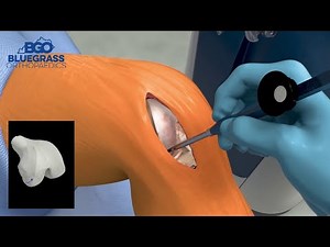Bluegrass Orthopaedics - Mako Total Knee Animation