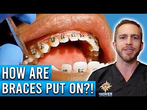 How Are Braces Put On?
